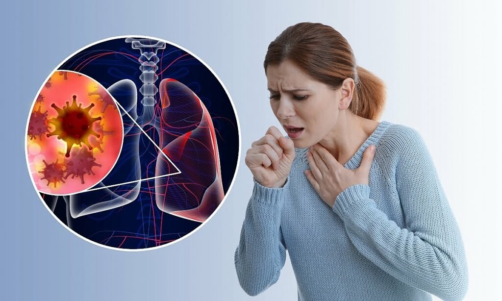 Ho khan thường là triệu chứng điển hình của viêm phổi