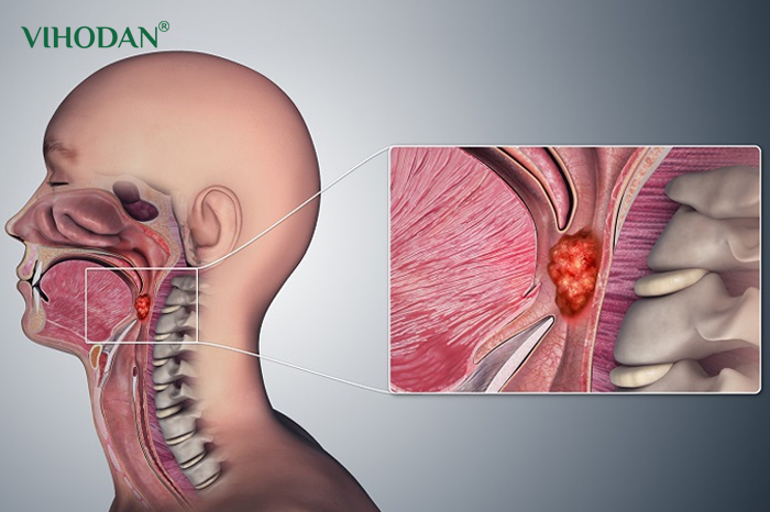 Ung thư vòm họng là căn bệnh nguy hiểm với triệu chứng khản tiếng có đờm